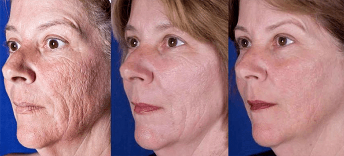 Rezultāts pēc sejas ādas atjaunošanas ar lāzeru