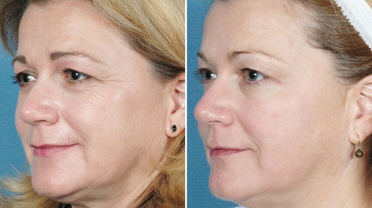 fotogrāfijas pirms un pēc aparatūras ādas atjaunošanas