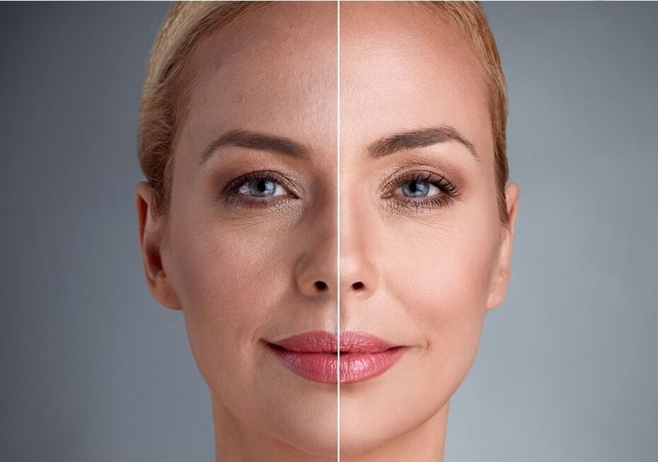 pirms un pēc lāzera sejas atjaunošanas