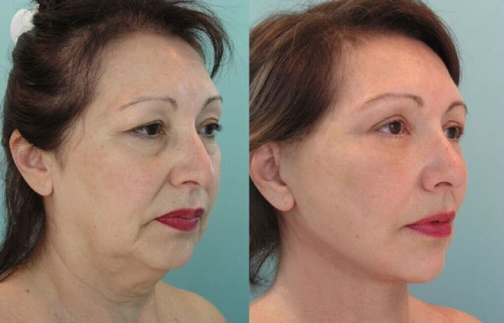 foto pirms un pēc ādas atjaunošanas