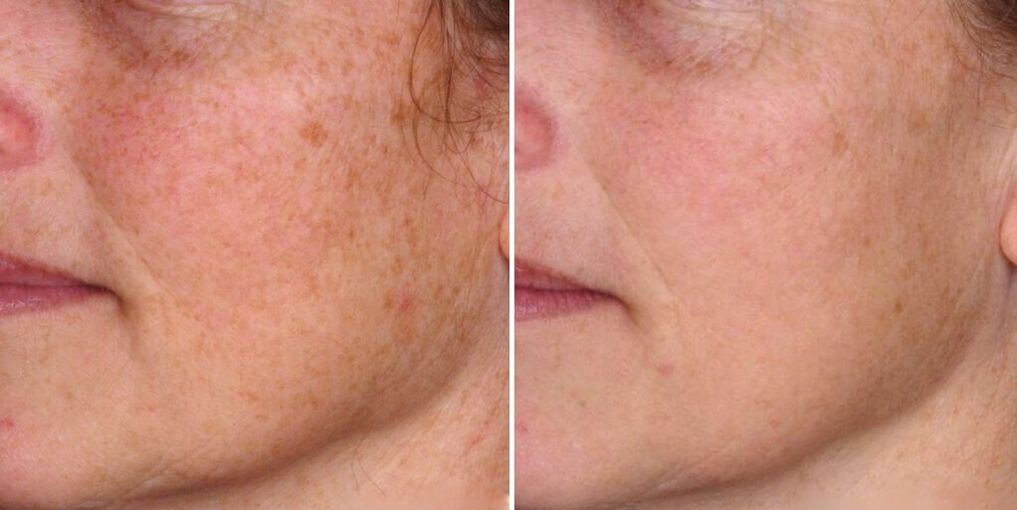 sejas āda pirms un pēc atjaunošanas